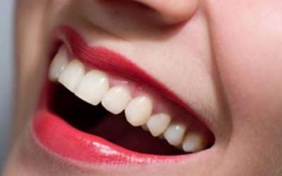 Teeth whitening, the touch on your smile!